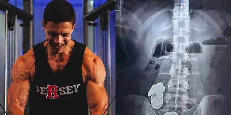 Fisicoculturista terminó en urgencias por comerse 39 monedas y 37 imanes Fisicoculturista terminó en urgencias por comerse 39 monedas y 37 imanes